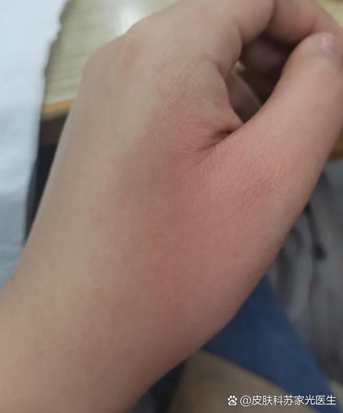 开水烫红了皮肤怎么办图标